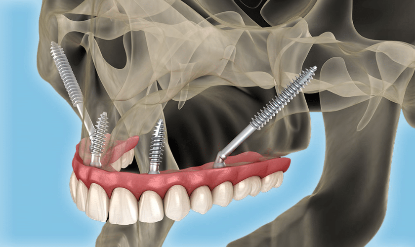 Zygomatic Implants A Game-Changer for Severe Jaw Bone Loss
