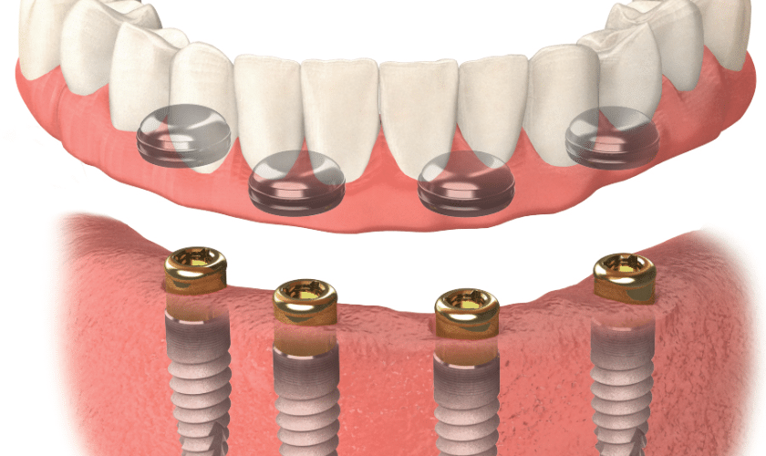 Unlocking SmilesThe Ultimate Guide to Implant Overdentures