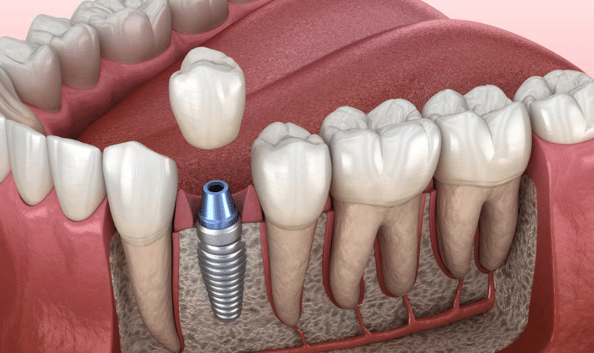 How Single Dental Implants Can Transform Your Smile