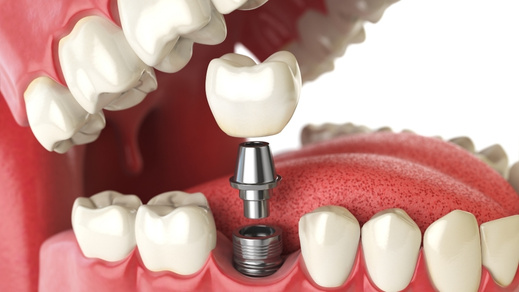 how long single dental implants last