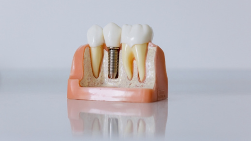 how to care for and maintain your dental implants