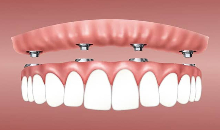 Implant Overdentures